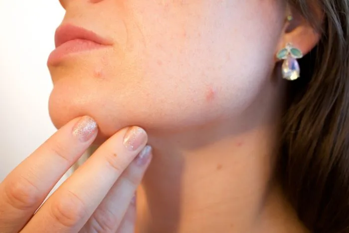 Cystic Acne - picking pimples