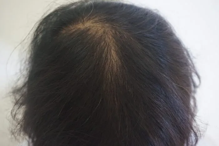 Hair Loss Treatment by Singapore Dermatologist