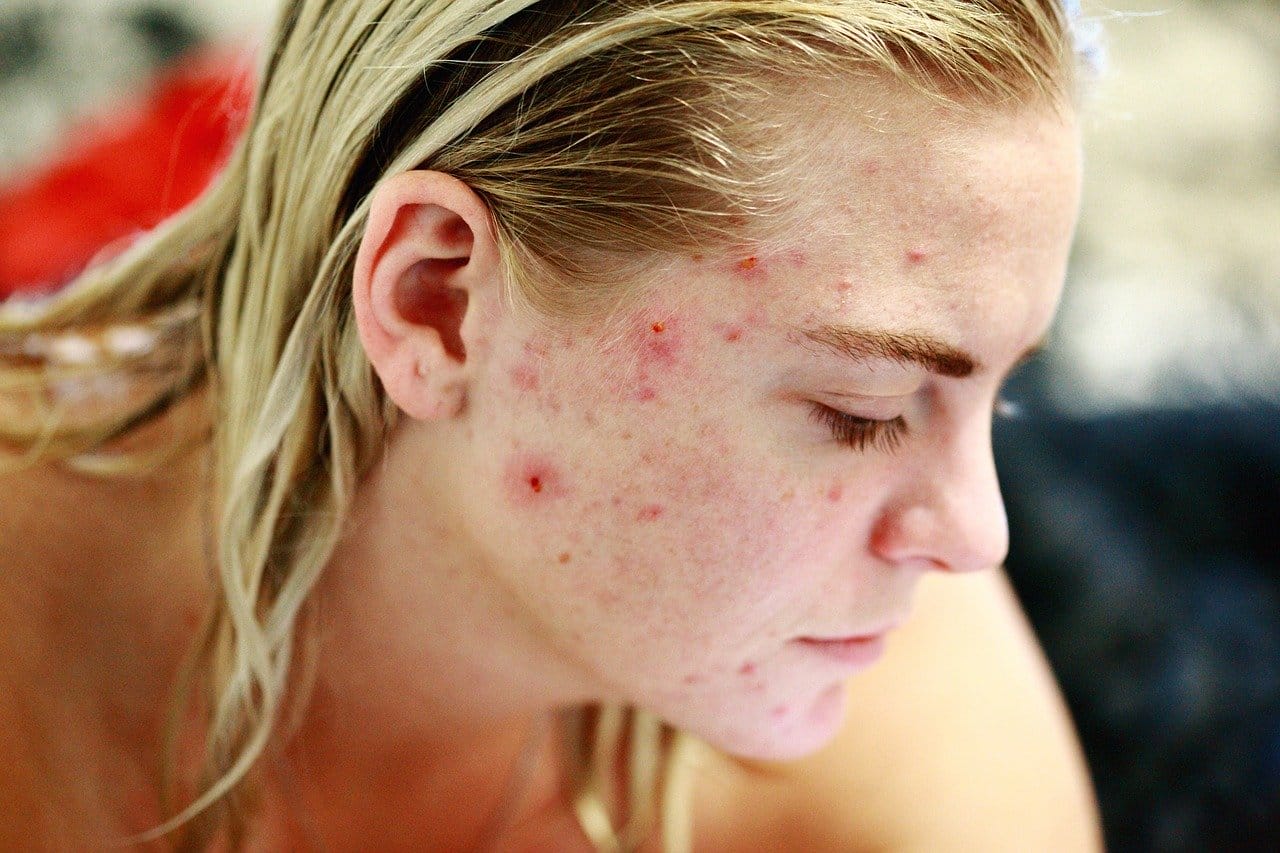 Acne Breakouts Tips Dermatologist Singapore