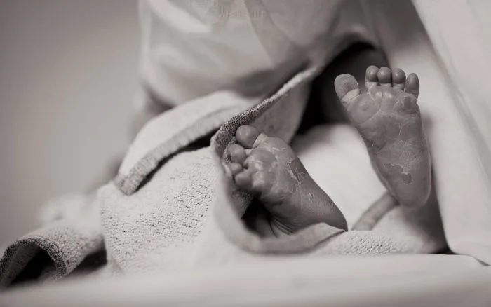 Baby Dry Skin Eczema Treatment
