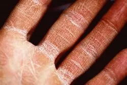 Eczema Treatment by Singapore Dermatologist