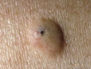 epidermoid cyst removal
