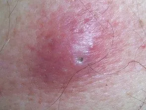 Inflamed cyst: epidermoid cyst removal