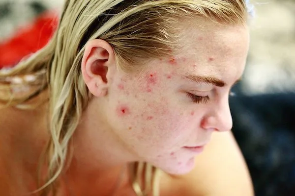 Acne Treatments Singapore Teledermatology