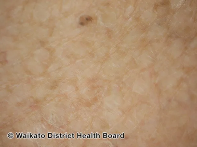Causes of Eczema with Ichthyosis Vulgaris