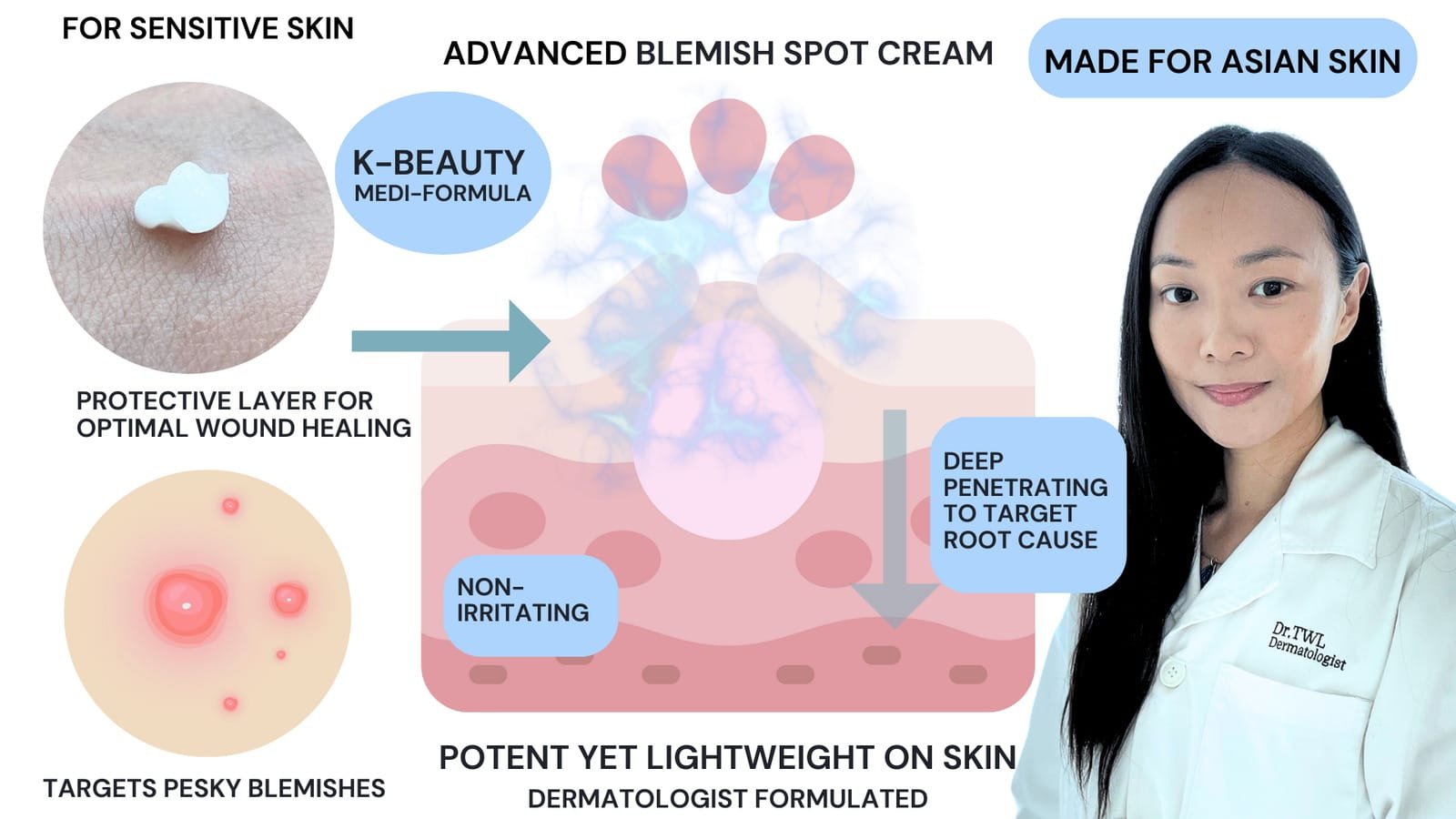 Holistic Acne Treatment with Plant Based Pimple Cream